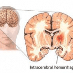 Intracerebral Hemorrhage – What Is It?