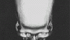 anicent skull that had brain surgery done it