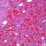 Cavernous Hemangiomas