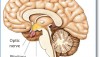 pituitary gland tumor image