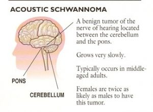 Acoustic Schwannoma