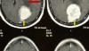 CT Scan - Benign Brain Tumour