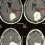 CT Scan - Benign Brain Tumour