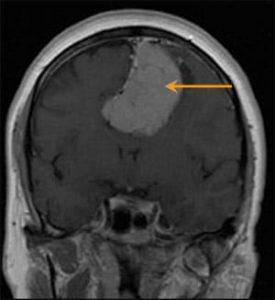 MRI Image of a frontal Meningioma