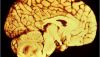 ependymoma brain tumor of 4th ventricle