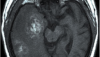 glioblastoma multiforme scan