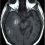 glioblastoma multiforme scan