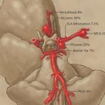 Aneurysm of The Posterior Inferior Cerebellar Artery – Occurrence and Prognosis