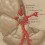 Cerebal aneurysms image