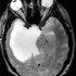 An Overview of Astrocytoma