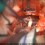 Microvascular Decompression of the Trigeminal Nerve