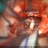 Microsurgical Decompression of Trigeminal Neuralgia