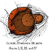 acoustic neuromas