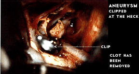 aneurysm surgery