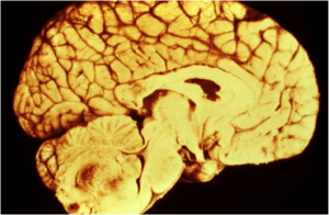 ependymoma brain tumor of 4th ventricle