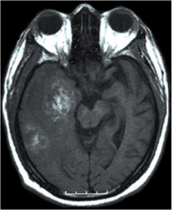 glioblastoma multiforme mri scan