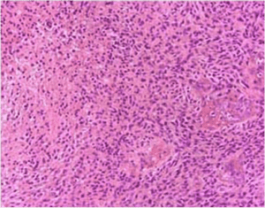 glioblastoma multiforme under the microscope image