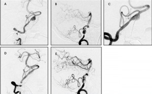 Aneurysm of the PICA image