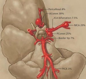 Cerebal aneurysms and PICA diagram