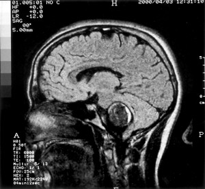 Sagittal FLAIR image