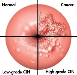 brain tumors in children