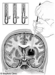 biopsy used during brain tumor treatments