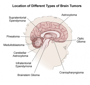 locations of brain tumors in children