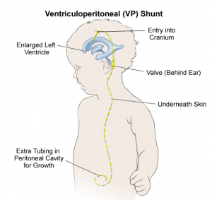 brain tumors in children vp shunt