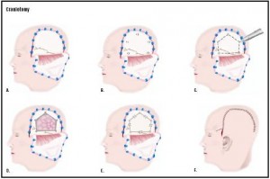 craniotomy procedure is brain tumor treatments