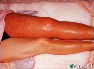 deep vein thrombosis