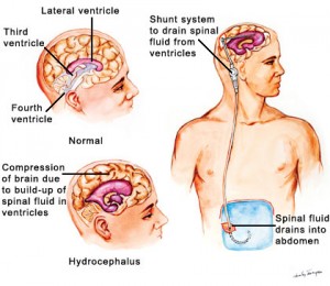 shunt placement in hydrocephalus another brain tumors treatments